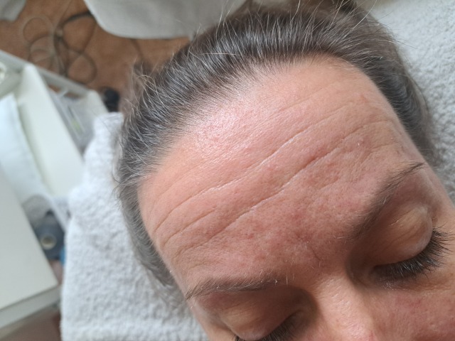 Omlazující techniky - před Omlazující techniky - před