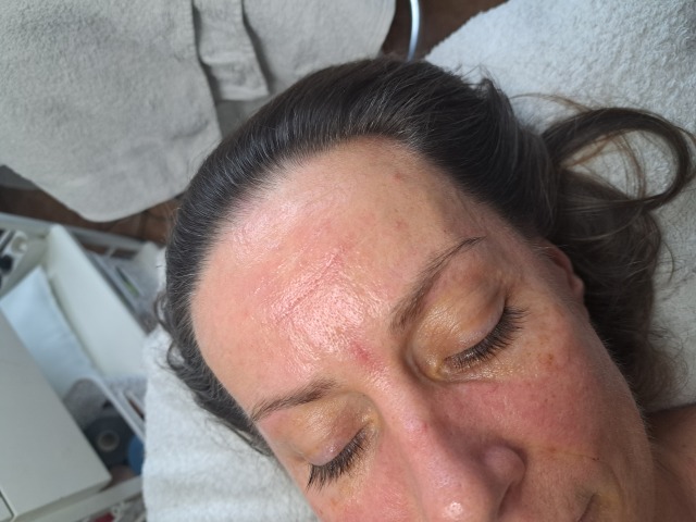 Omlazující techniky - po Omlazující techniky - po